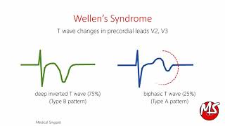 Wellens Syndrome with ECG and Angiography example