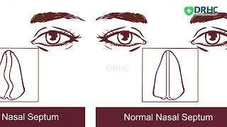 Nasal Septum - Dr. Hatem Eliwi | Otolaryngology Clinic | Dr. Rami Hamed Center