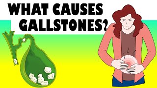 What Causes Gallstones? Major Causes Of Gallstone Disease |Gallstones Causes