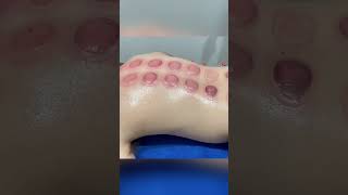 cupping therapy करने से क्या फायदा है #shorts