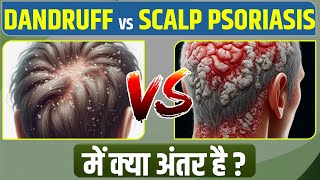 ✅ Dandruff VS Scalp Psoriasis | Difference Between Dandruff and Scalp Psoriasis In Hindi