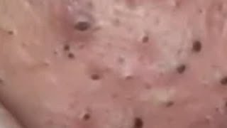 Huge Acne Pimples Blackheads Popping Up Satisfying with Oddly Calm Music Part One