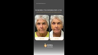 Remarkable Results: Lower Face High SMAS with Neck Lift and Twilight Anesthesia