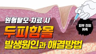 원형탈모 치료 시 두피함몰이 생기는 이유와 해결방법