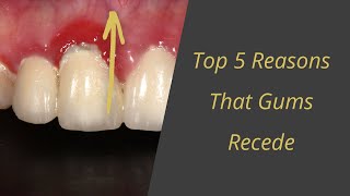 5 Reasons that you can get Gum Recession