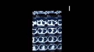 Demonstration of Emphysema on CT scan chest