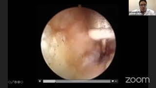 Step-by-Step Approach to Hip Arthroscopy