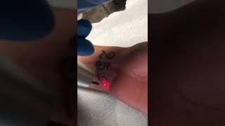 Laser tattoo removal on Wrist tattoo removal to join the army l