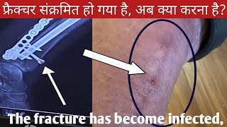 Tibia Fibula Fracture Recovery|The fracture has become infected|फ्रैक्चर संक्रमित हो गया है