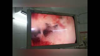 Hysteroscopic Polypectomy. Slicing technique details@vivekanandahospitalofficial