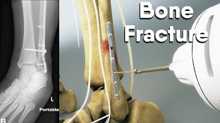 Tibia fractures are the most common lower extremity fractures|Dandelion Team #Tibia #Open_reduction