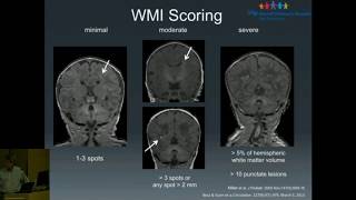 Neurodevelopment in CHD: Brain Imaging & Optimizing Outcomes