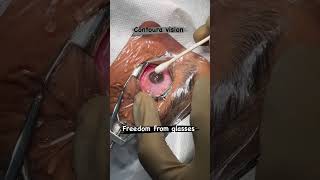 Contoura Vision: Freedom from Glasses | Treatment by Dr. Advaith Sai Alampur