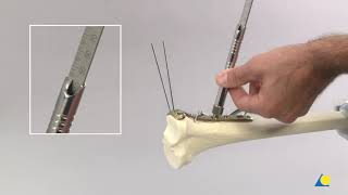 Principles of Internal Fixation with Screws and Plates