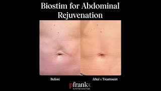 Biostimulatory Filler for Abdominal rejuvenation