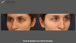 Rhinoplasty in Korea (Caucasian) by Dr. Man Koon, Suh from JW Plastic Surgery Korea