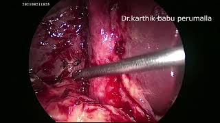 laparoscopic cholecystectomy for mirrizi's syndrome with empyema of gall bladder and cholangitis.