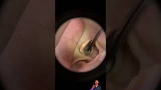 Ear Wax Removal