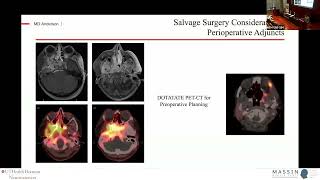 Salvage Management of Recurrent Meningiomas | MASSIN Congress Day 3 | Session , Talk 4