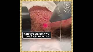 Ablative Erbium YAG Laser- Dr Fazeela Abbasi