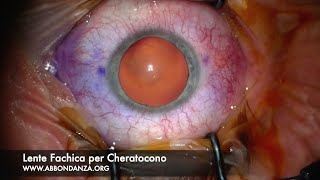 Lenti Cheratocono: Lenti Fachiche per Cheratocono - Dr. Abbondanza