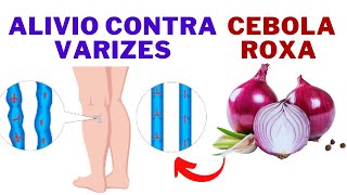 🌿Alivie Varizes Naturalmente com Cebola Roxa Receita Eficaz para Pernas Saudáveis🌿🩺