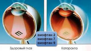 Применение флуревитов при различных видах катаракты