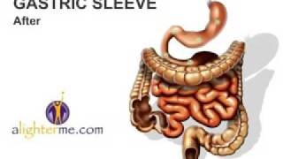 Vertical Sleeve Gastrectomy Weight Loss Surgery