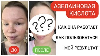 АЗЕЛАИНОВАЯ КИСЛОТА | Мой опыт использования + ФОТО | Как работает Азелик гель ?