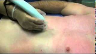 Laser Hair Removal Treatment, Ipl Hair Removal, Del Mar, (8