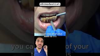 TEETH JUMPED AND GONE? Dentist Reacts #gumdisease #periodontist #periodontaldisease