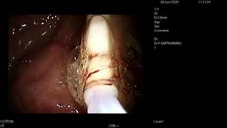 Endoscopic removal of denture stuck in the Esophagus