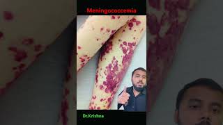 Meningococcemia #drkrishna #neet #mbbskyrgyzstan #biology #ihsm #science