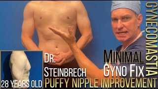 Gynecomastia (Man Boobs) Procedure Reveal by Dr. Steinbrech