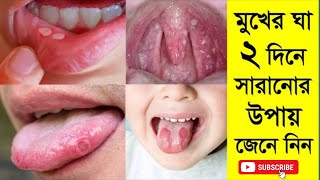 মুখের ঘা দূর করার উপায়-mukhe gha hole ki korbo-মুখে ঘা হলে কি করবেন-মুখের ঘা সারানোর উপায় Trilon