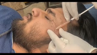 Scar Removal Treatment With Co2 Laser Resurfacing || Dr.Arif Iqbal