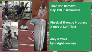 Tibia Rods Removal (Precice 2.2 Nails) - Day 110 after Surgery, X-rays, Physical Therapy Progress