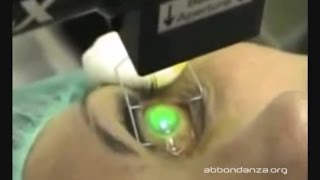 Corneal Collagen Cross-linking for keratoconus - Dr. Marco Abbondanza