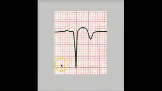 PATHOLOGIC Q WAVE