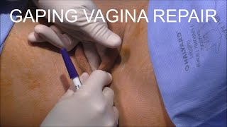 The Gaping Vagina: Why it Happens & How to Fix It