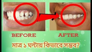 Teeth Gap Close treatment cost in bangladesh l Tech Dental Care