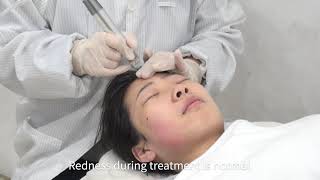 Hydra Facial operation