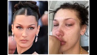 BELLA HADID Shared How LYME Disease is Changing her Life