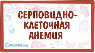 Серповидно-клеточная анемия  — причины, симптомы, патогенез, диагностика, лечение