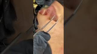 Blackheads in Ear