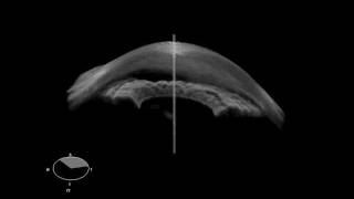 SS-1000 Anterior Chamber OCT 3D View