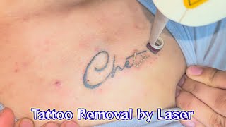 LASER TATTOO REMOVAL- R20 TECHNIQUE/लेजर द्वारा टैटू का इलाज @DesignerDoctor #skinspecialist #dermat