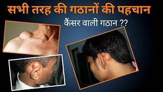 BODY की सभी तरह की गठानों पहचाने | कैंसर की गठान है या नहीं।