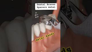 Orthodontics Metal Bands