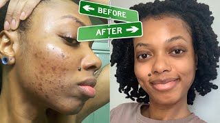 How I Got Rid Of My ACNE & HYPERPIGMENTATION